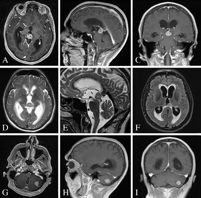 Pineal Gland Metastasis From Poorly Differentiated Carcinoma of Unknown Primary Origin